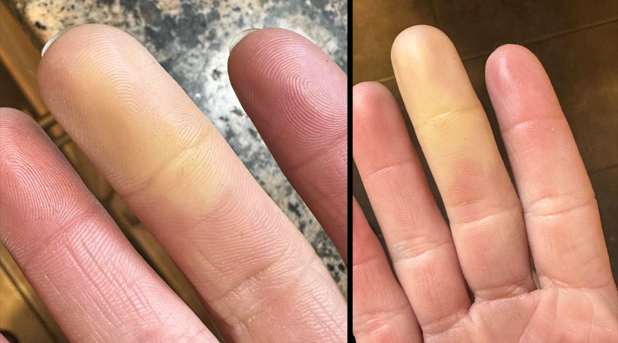 Une patiente atteinte de la maladie de Raynaud